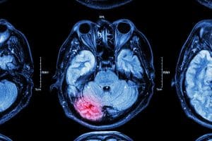 Understanding Types of Brain Injuries